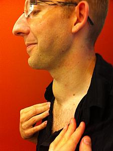 Jay's neck (showing the goiter)before his Thyroidectomy.