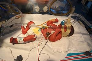 She's hooked up to lots of monitors, and to a CPAP machine to assist with her breathing.